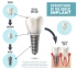 Mit jelent a fogászati implantátum?